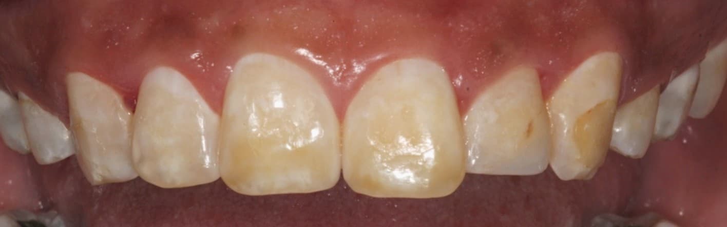 Antes: Diseño digital de sonrisa